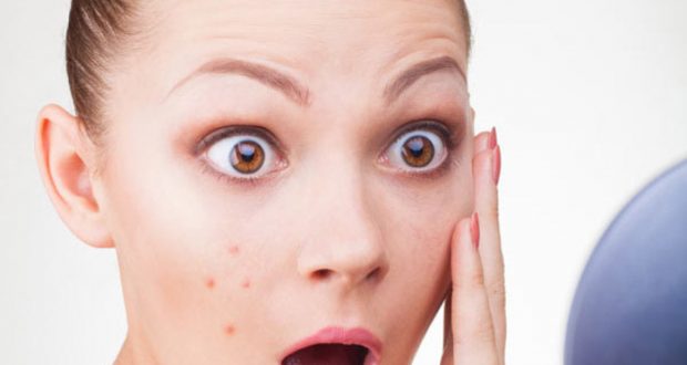 В Киеве фиксируют десятки случаев ветрянки среди взрослых. Основные симптомы